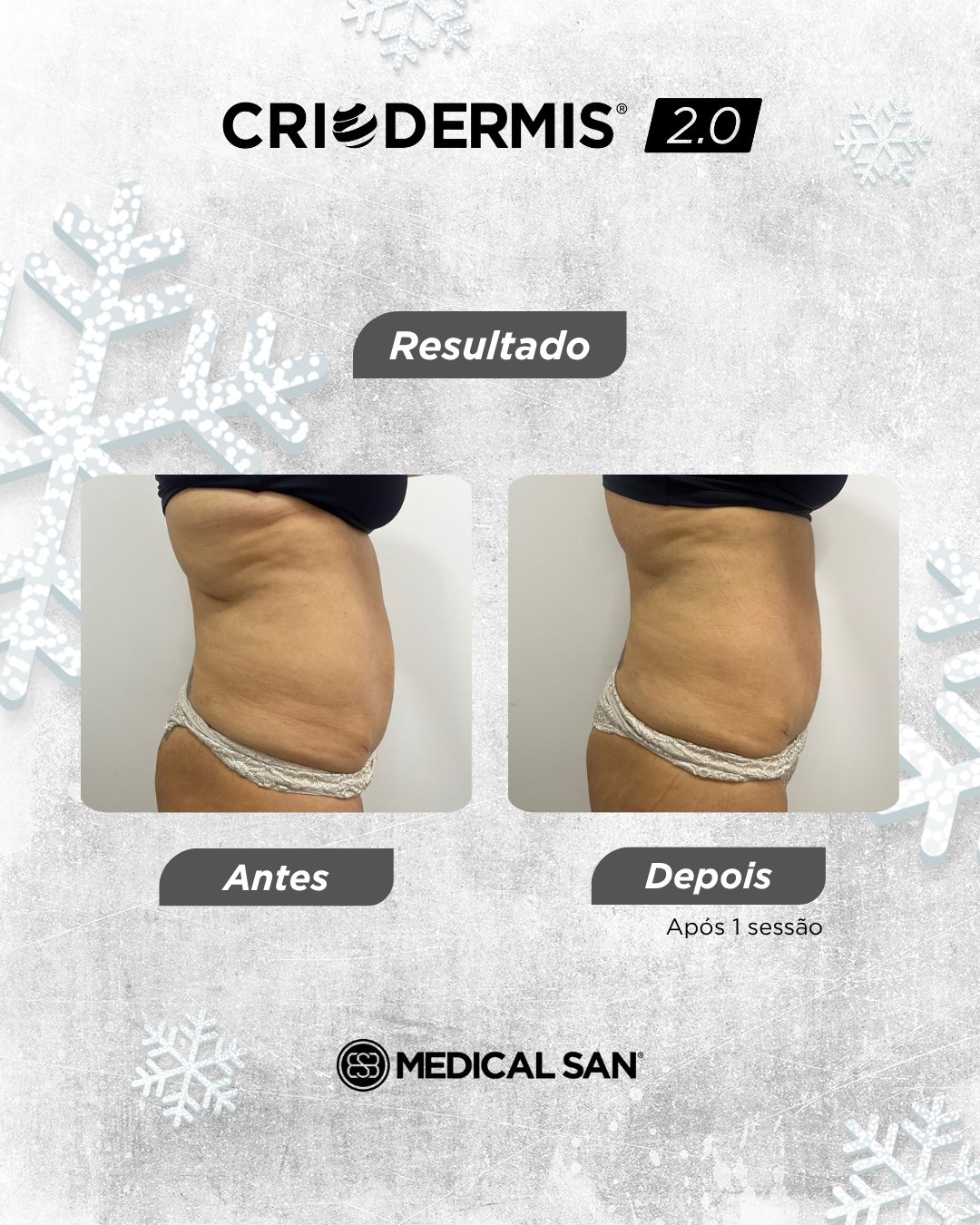 Antes e depois de criolipólise — Criodermis 2.0