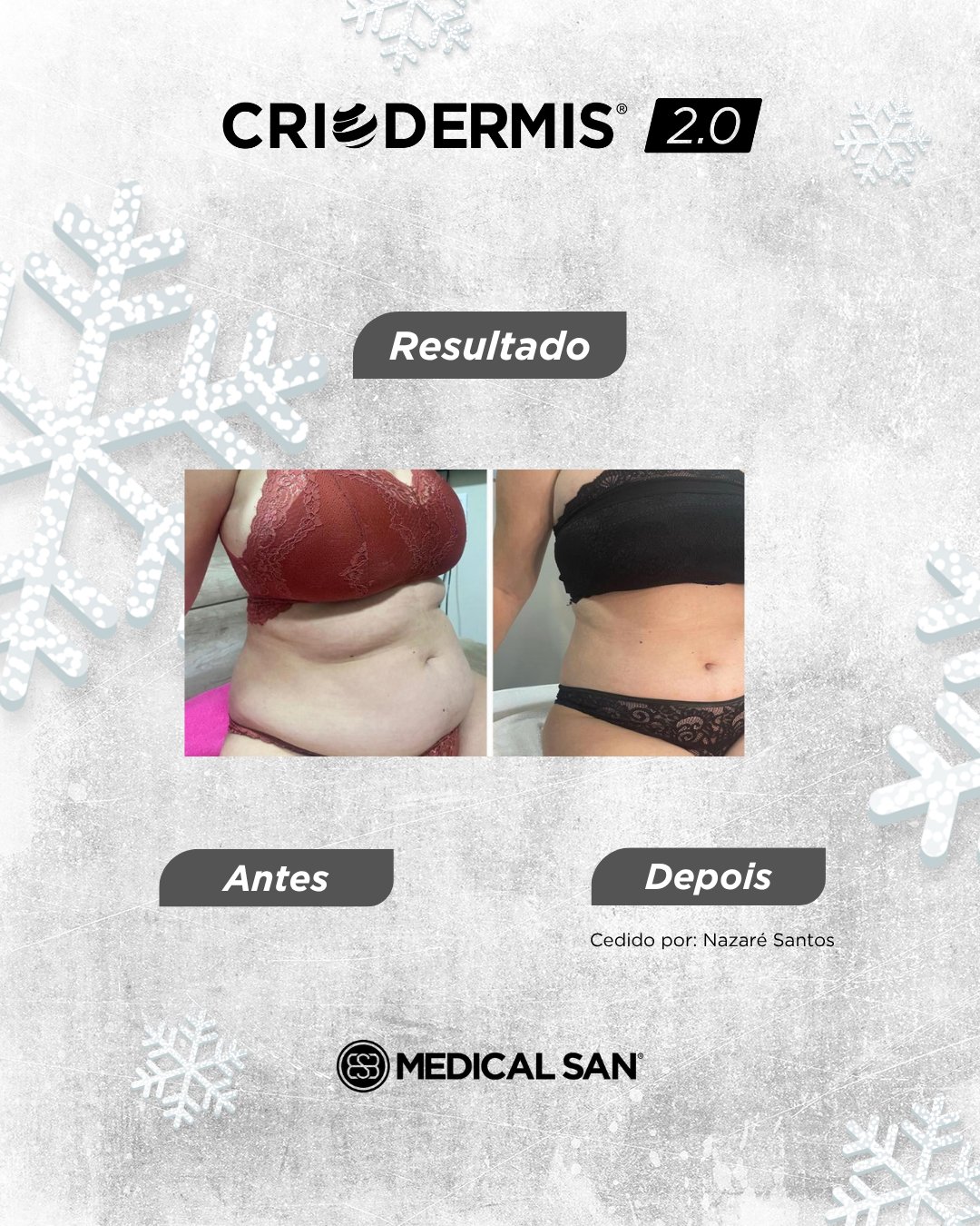 Antes e depois de criolipólise — Criodermis 2.0