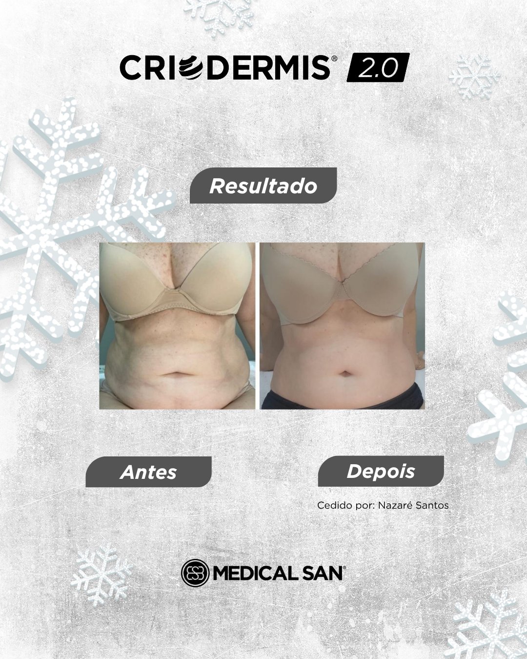 Antes e depois de criolipólise — Criodermis 2.0