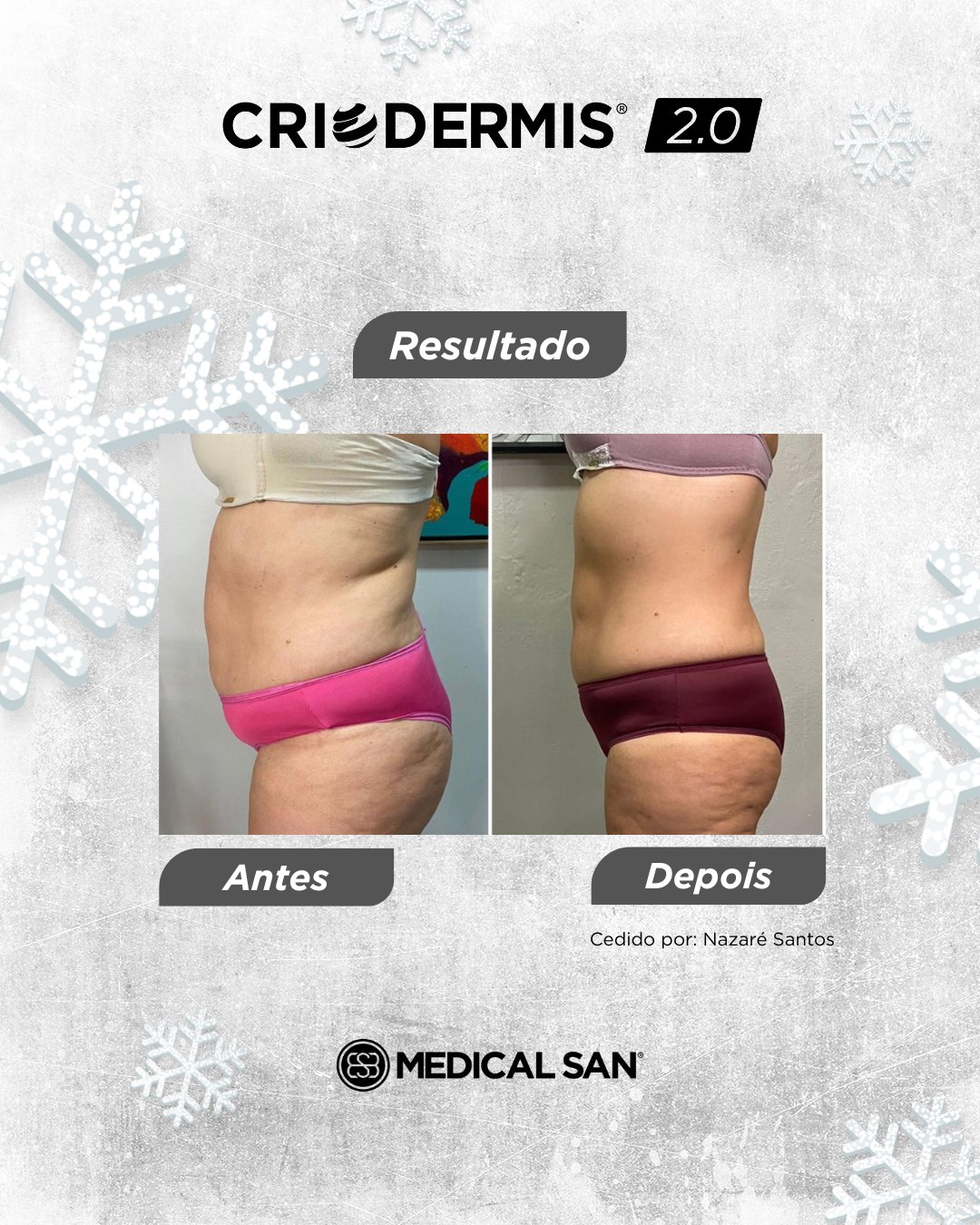 Antes e depois de criolipólise — Criodermis 2.0