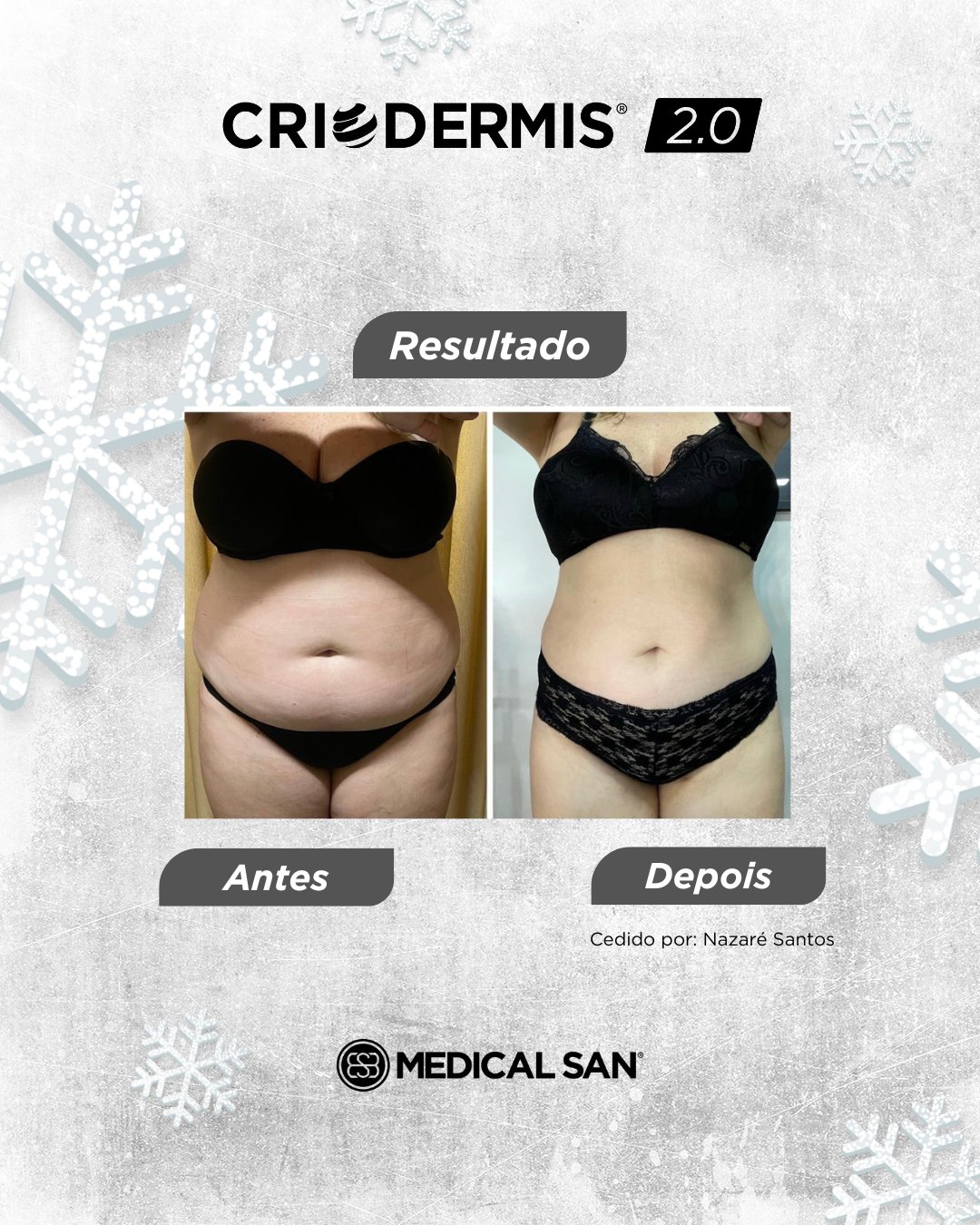 Antes e depois de criolipólise — Criodermis 2.0