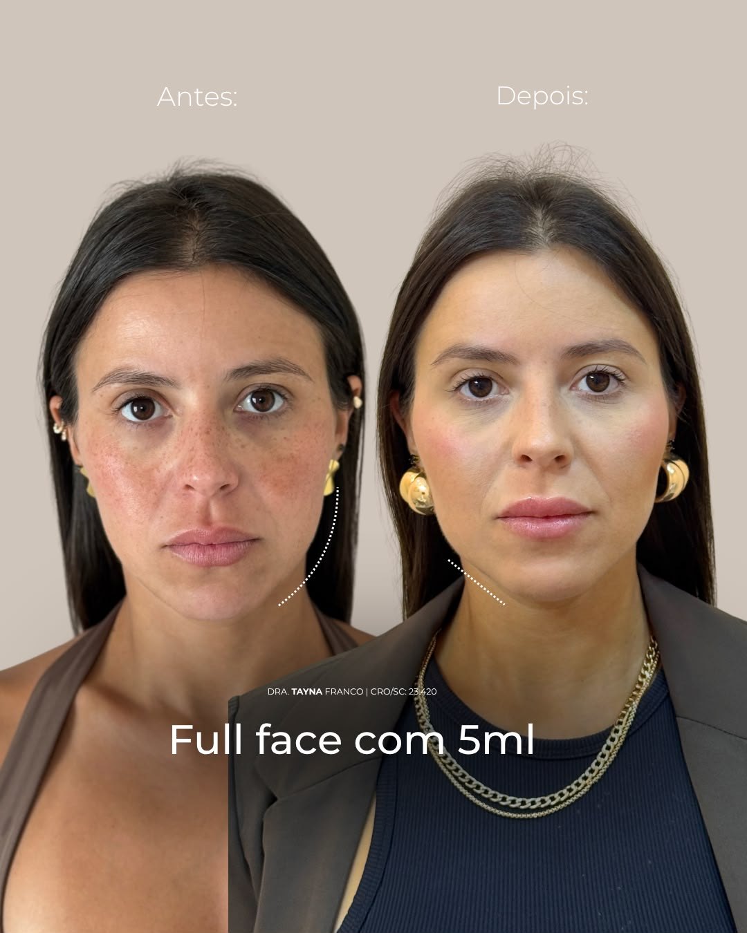 Antes e depois — full face pela Dra. Tayná Franco