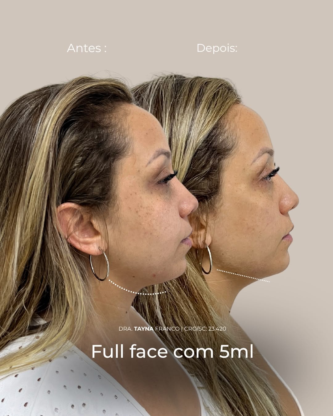 Antes e depois — full face pela Dra. Tayná Franco