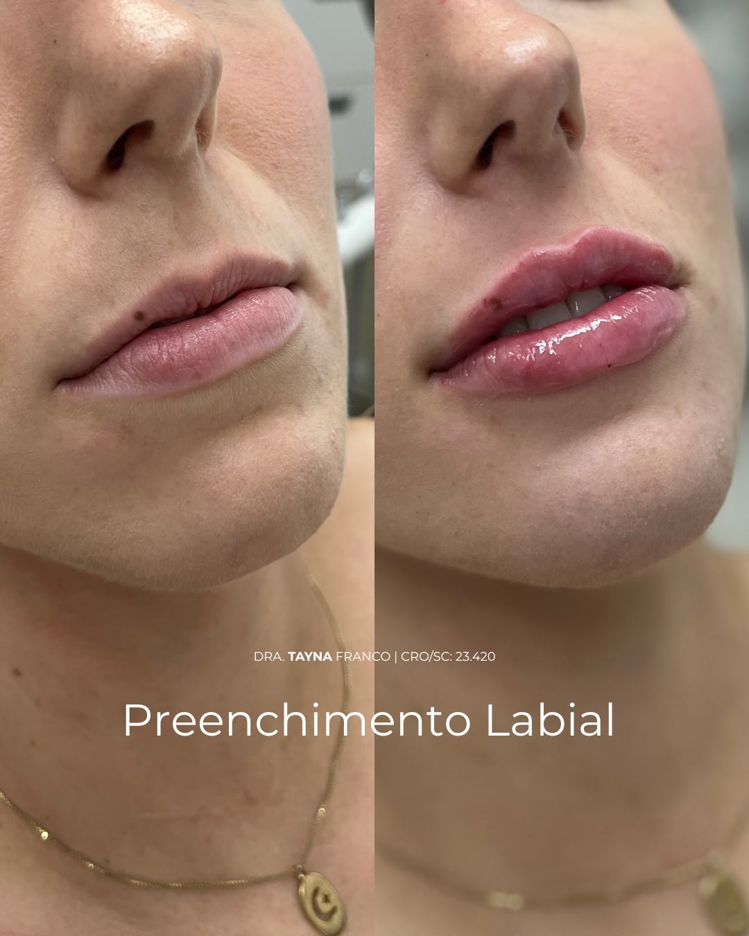 Antes e depois — preenchimento labial pela Dra. Tayná Franco