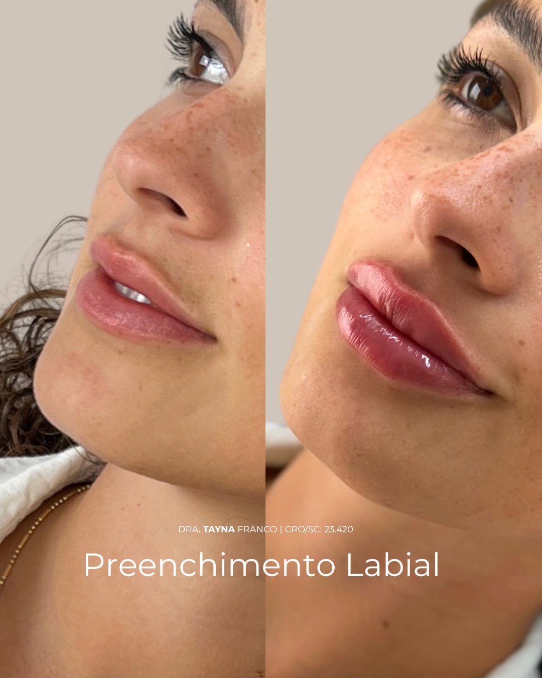 Antes e depois — preenchimento labial pela Dra. Tayná Franco