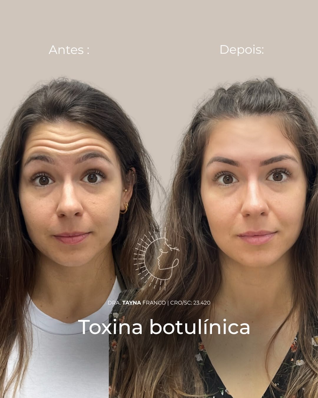 Antes e depois — toxina botulínica pela Dra. Tayná Franco