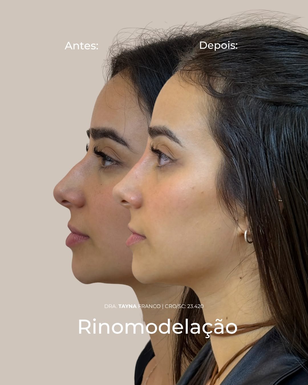 Antes e depois — rinomodelação pela Dra. Tayná Franco