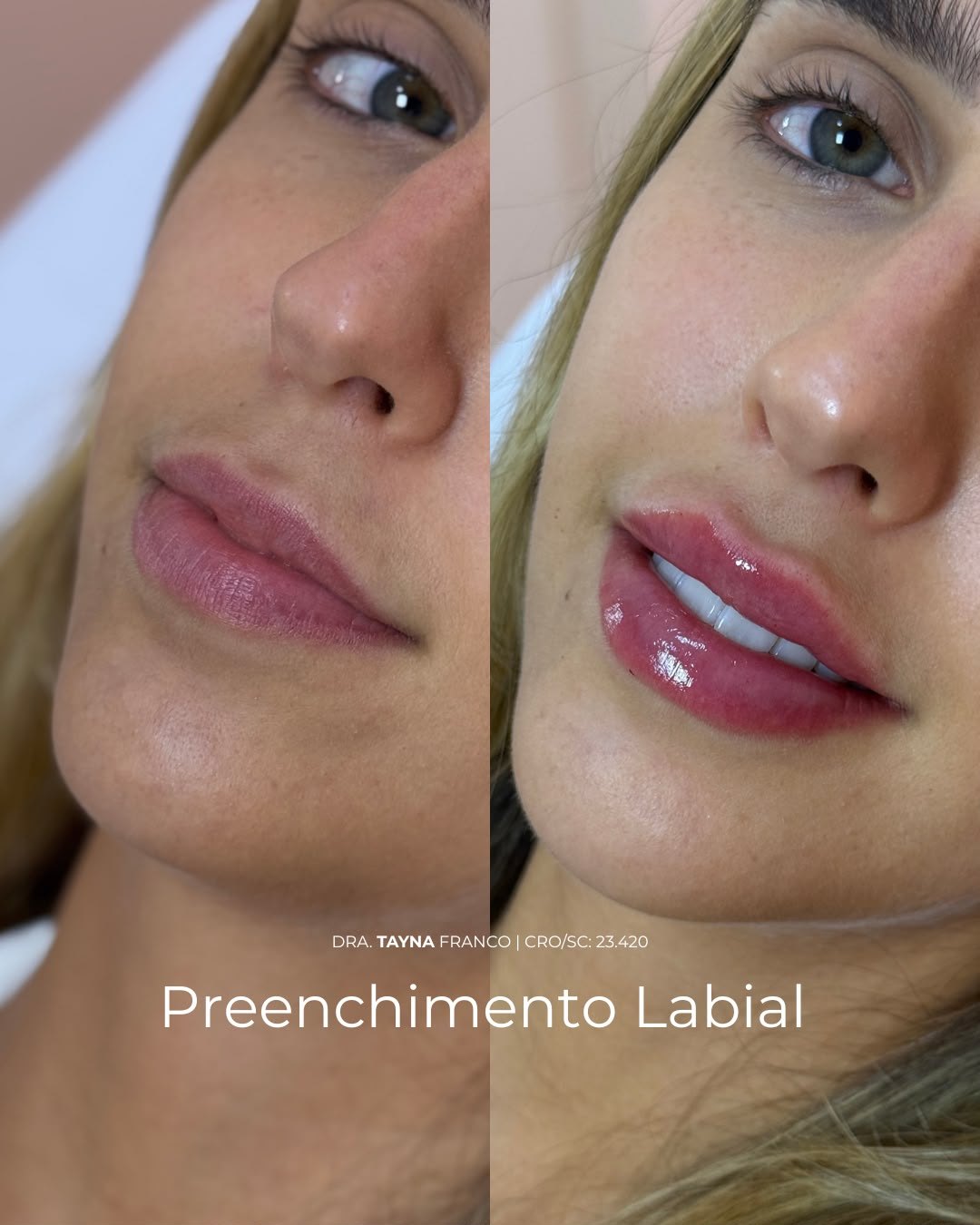 Antes e depois — preenchimento labial pela Dra. Tayná Franco