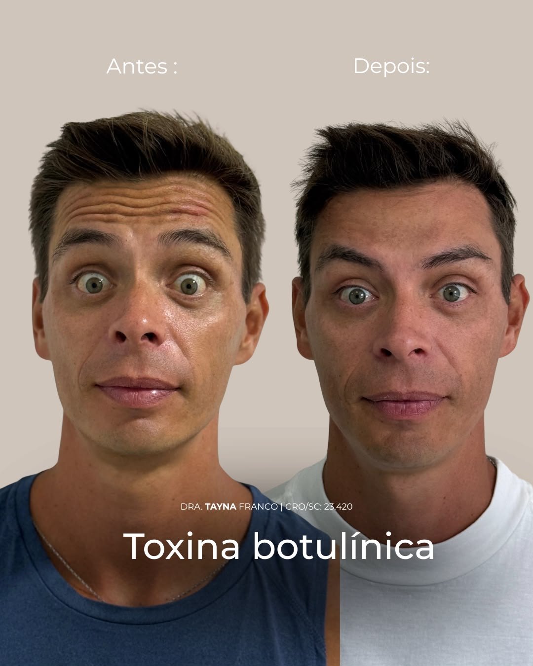 Antes e depois — toxina botulínica pela Dra. Tayná Franco