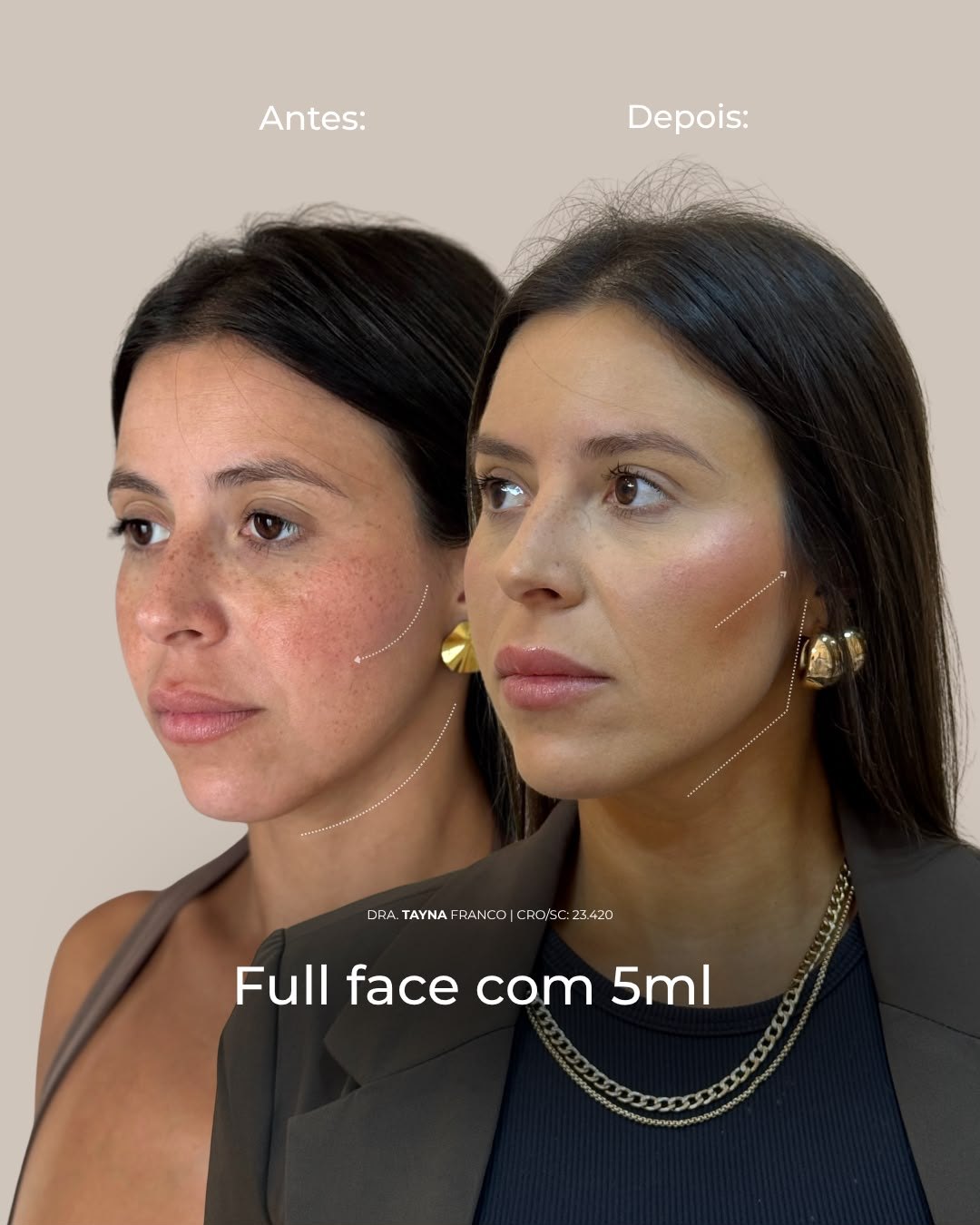 Antes e depois — full face pela Dra. Tayná Franco