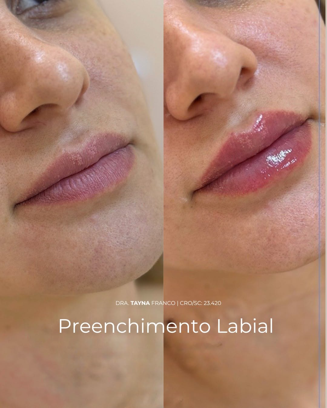 Antes e depois — preenchimento labial pela Dra. Tayná Franco