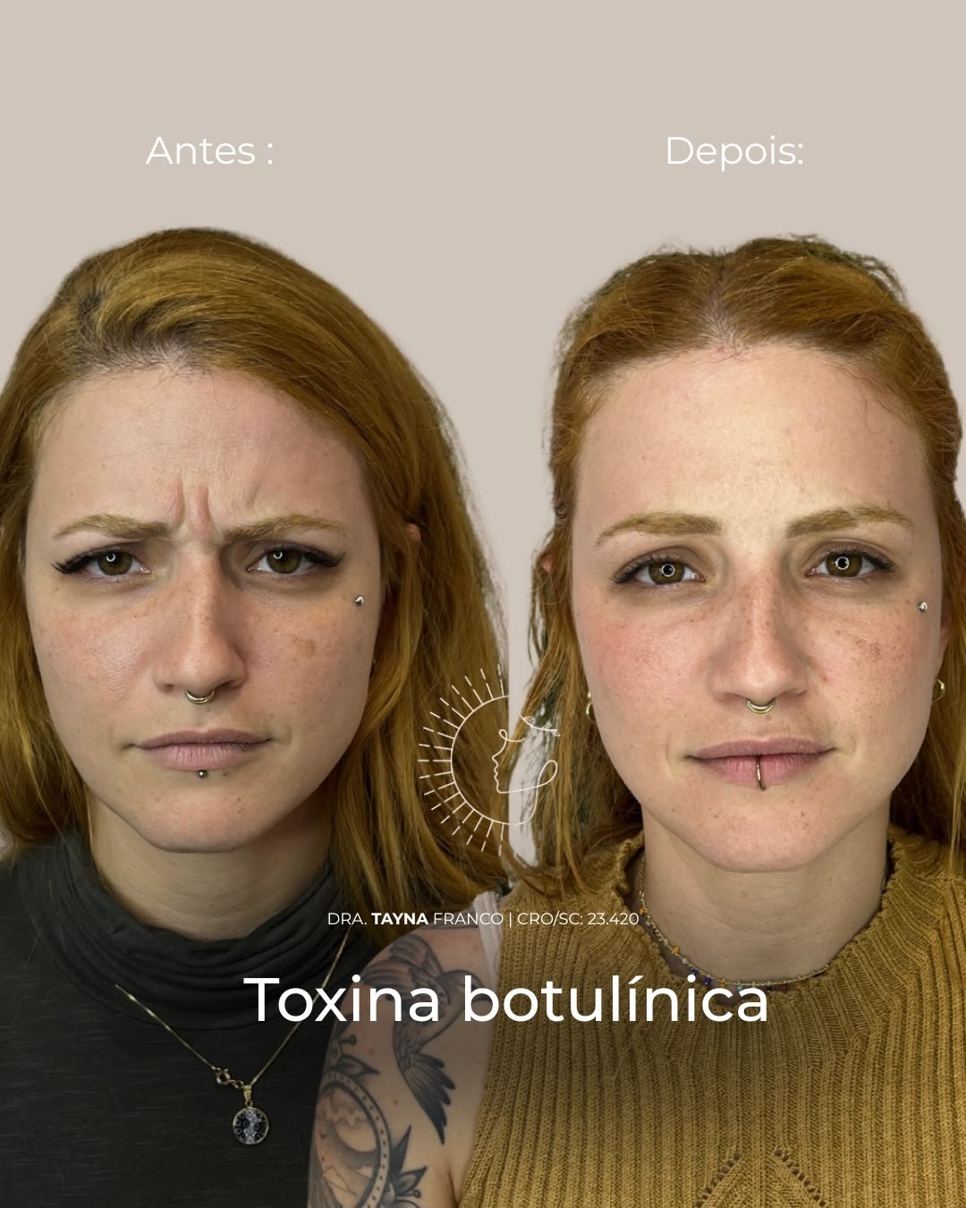 Antes e depois — toxina botulínica pela Dra. Tayná Franco